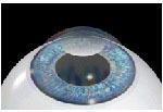 Lasik2